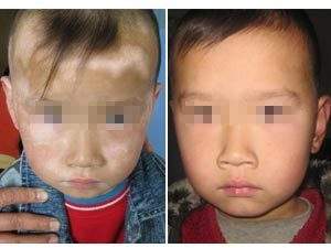 白癜风患者喝水要注意哪些呢