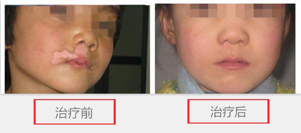 白癜风的护理从哪里做起