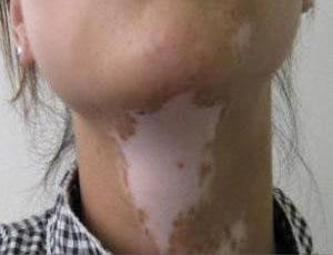 白癜风要如何预防扩散