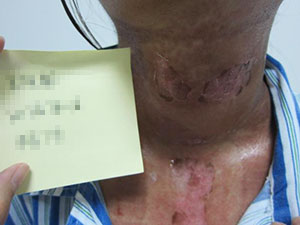 患有白癜风需注意哪些饮食特点呢