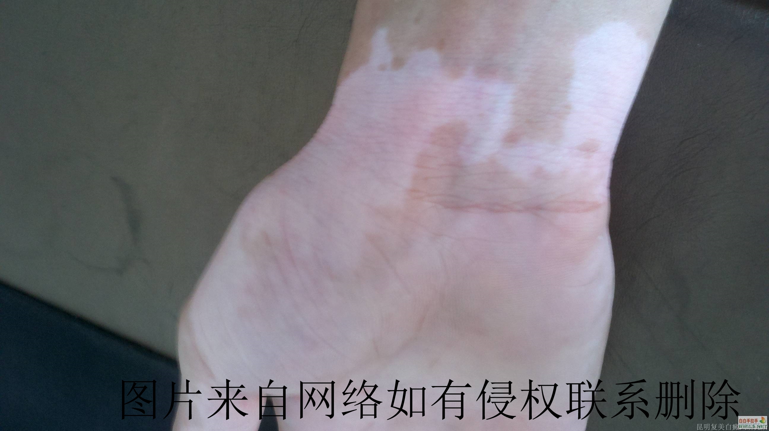 白癜风患者要怎么调节精神情绪