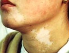 男性白癜风要如何做正确的护理呢