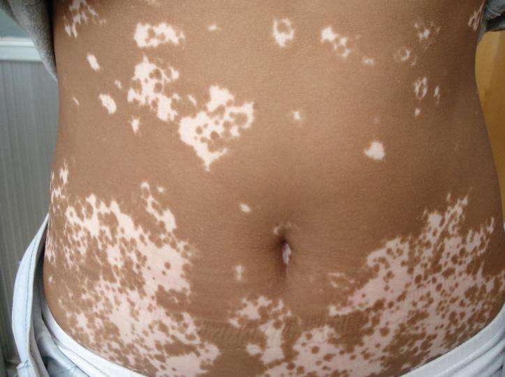 治疗白癜风之前要做哪些检查