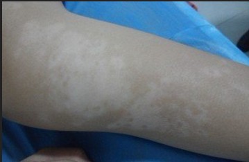 白癜风要怎么判定诊断呢