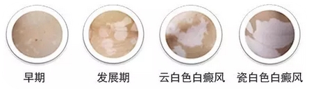 广州白癜风早期症状有何特点