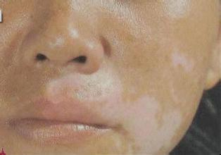 白癜风具体症状特点表现在哪