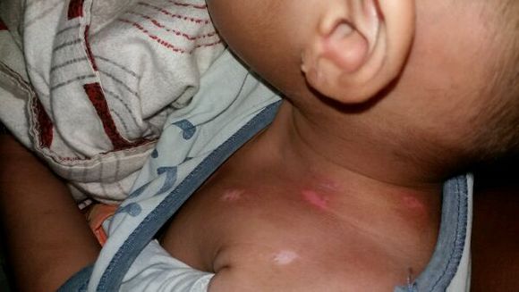 白癜风患者怎么精准的检查好