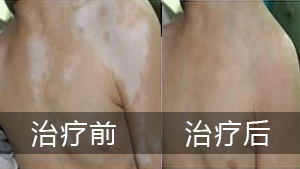 白癜风会给患者带来哪些损害呢