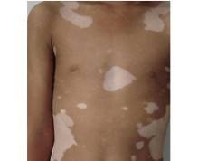 白癜风的危害有哪些