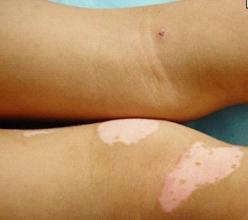 白癜风图片 白癜风图片