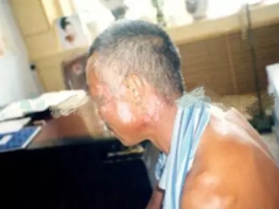 面部白癜风会带给患者哪些负面情绪