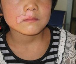 广州白癜风治疗关键所在