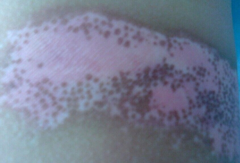 白癜风初期要怎么治疗好呢