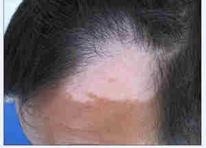 白癜风来了，要怎么赶走