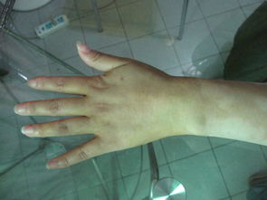 白癜风图片 白癜风图片