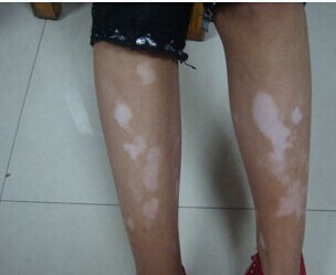 腿部得了白癜风应该如何治疗