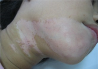 白癜风不治疗可以吗