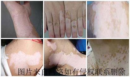 白癜风治疗注意些什么才能助于康复