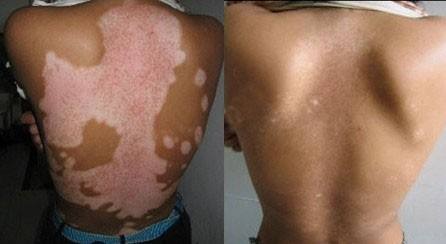 广州患白癜风要怎么能治好