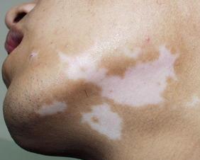 影响孩子治疗白癜风的因素有什么呢