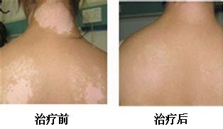 白癜风早期治疗能早点康复吗