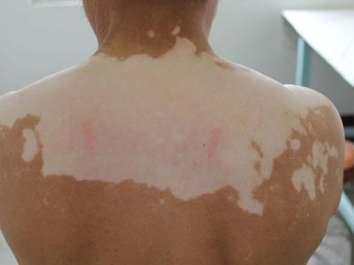 背部白癜风的患病原因有哪些