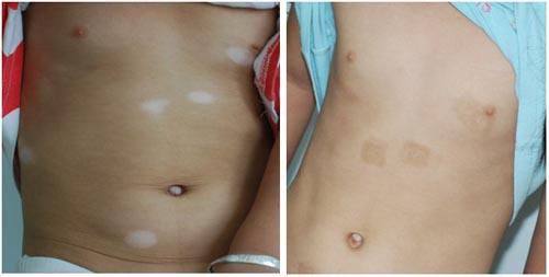 美丽女性患上白癫风的原因是什么