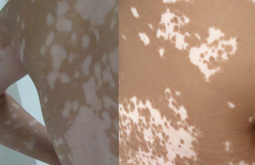 白癜风早期治疗中应该注意哪些