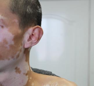 老年白癜风治疗应该注意的事项有哪些