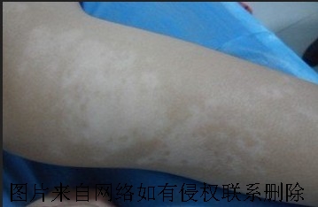 白癜风会患上是因为什么呢