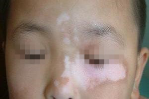 白癜风的治疗方法有哪些