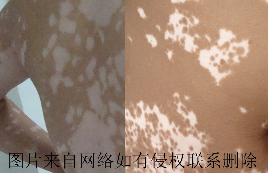 青少年白癜风要怎么治疗呢