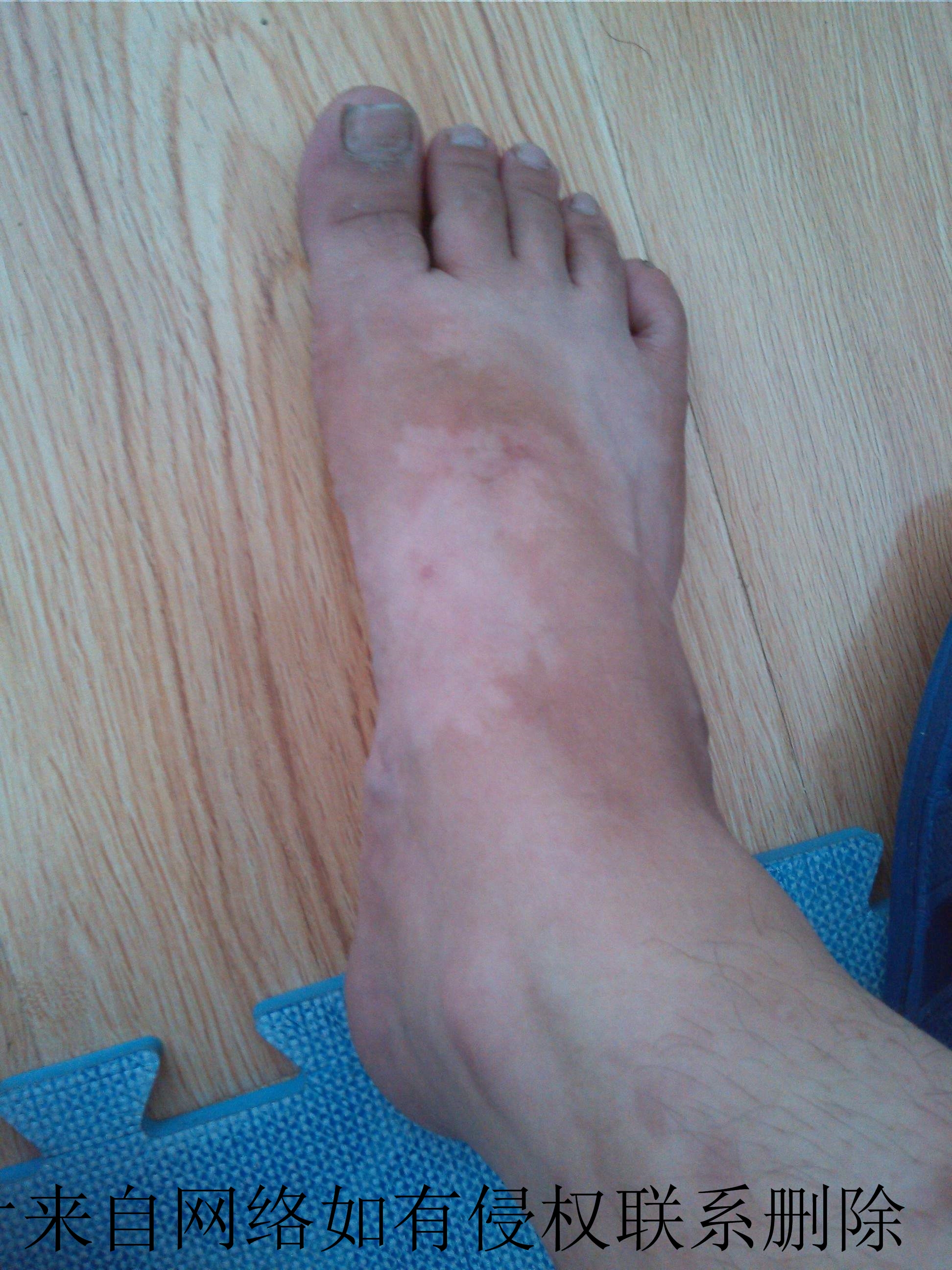 脚趾头上白癜风要如何治疗好