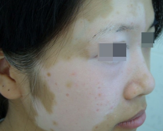 白癜风治疗遵循四个原则，摆脱疾病