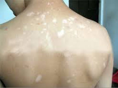 患白癜风要怎么办才好呢